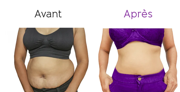 Avant / après lipocavitation BodySano