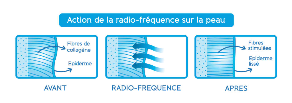 radiofrequence-BodySano